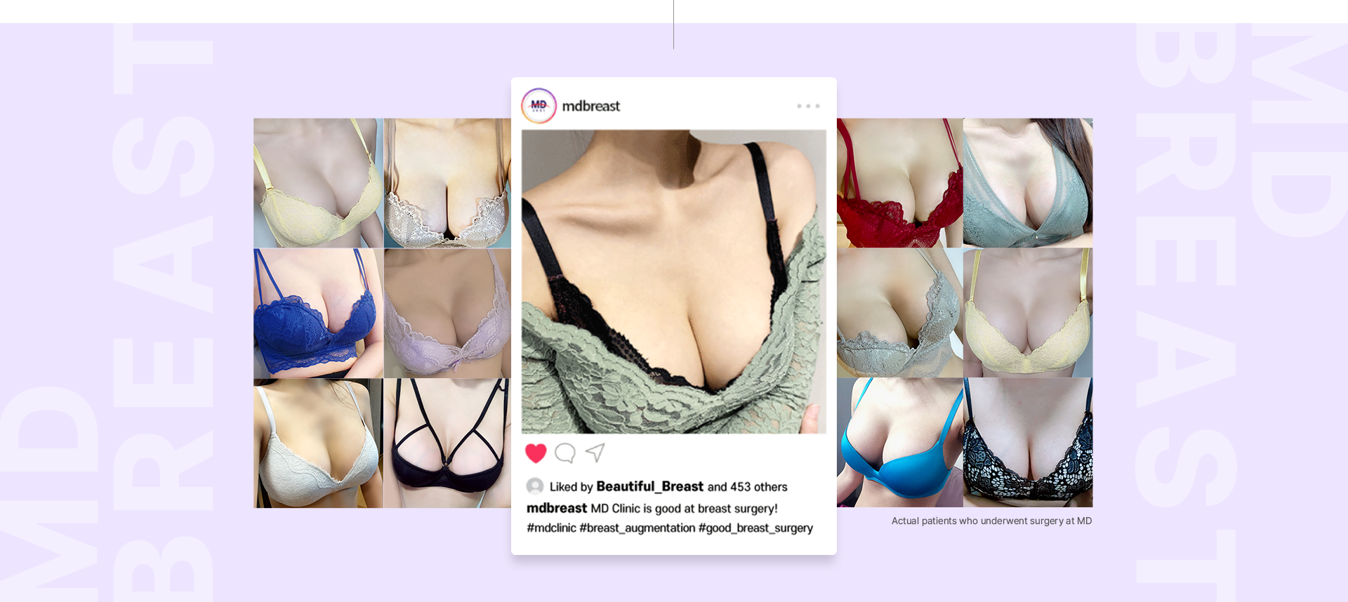 Breast Augmentation