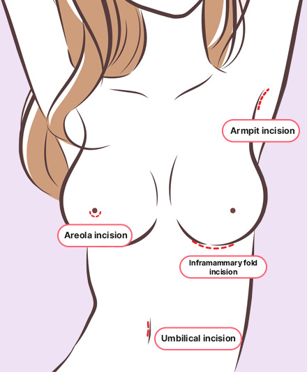 Breast Augmentation