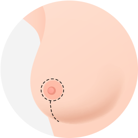 Breast Reduction