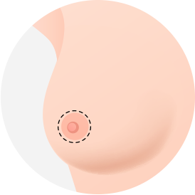 Breast Reduction