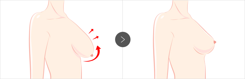 Post-Childbirth Breast Lift