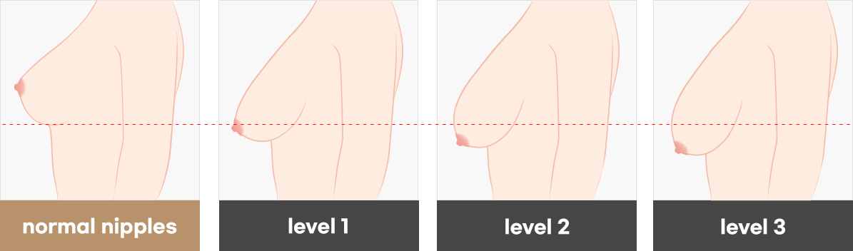 Correction of Sagging Breast
