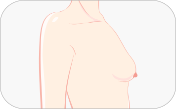 Correction of Sagging Breast