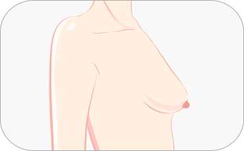 Correction of Sagging Breast