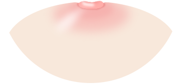 Nipple and Areola Surgery