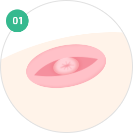 Nipple and Areola Surgery