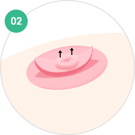 Nipple and Areola Surgery