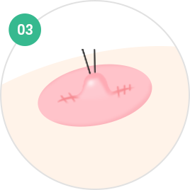 Nipple and Areola Surgery