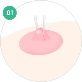 Nipple and Areola Surgery
