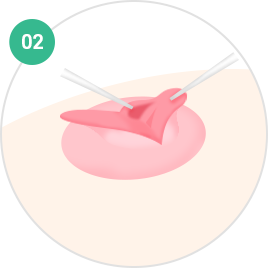 Nipple and Areola Surgery