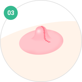 Nipple and Areola Surgery