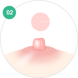 Nipple and Areola Surgery