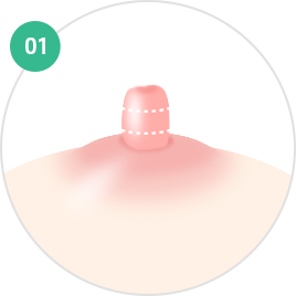 Nipple and Areola Surgery