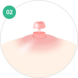 Nipple and Areola Surgery