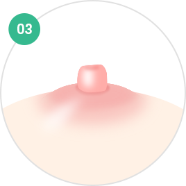 Nipple and Areola Surgery