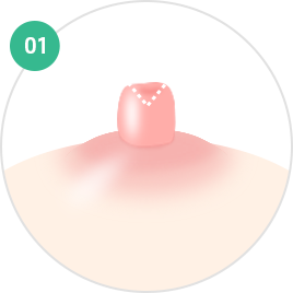 Nipple and Areola Surgery