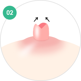 Nipple and Areola Surgery