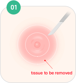 Nipple and Areola Surgery