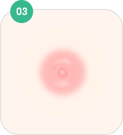 Nipple and Areola Surgery