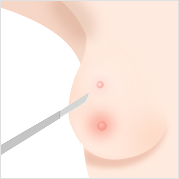 Accessory Breast Removal
