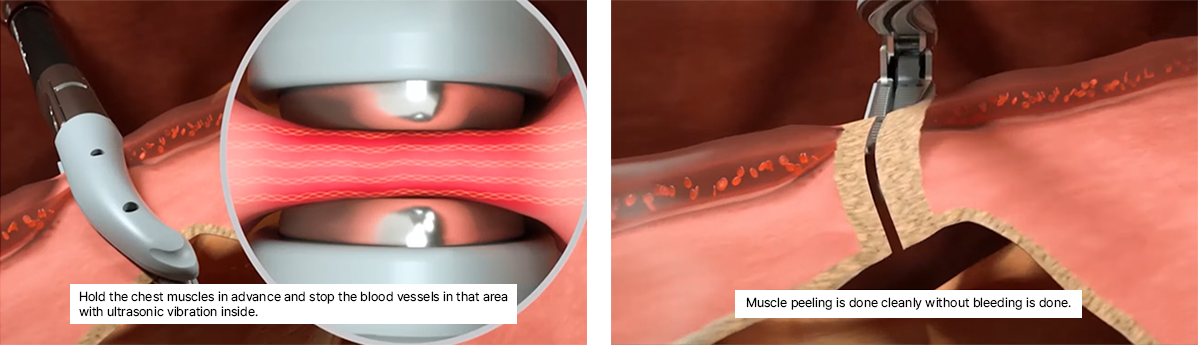 MD Bloodless Breast Surgery