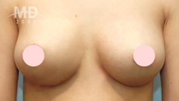 Breast Revision Surgery
