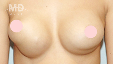 Breast Revision Surgery