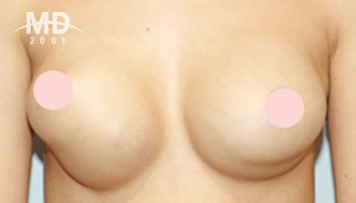 Breast Revision Surgery