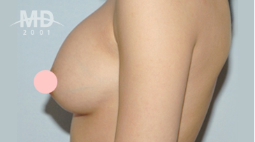 Breast Revision Surgery