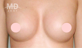 Breast Revision Surgery
