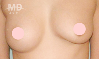 Breast Revision Surgery