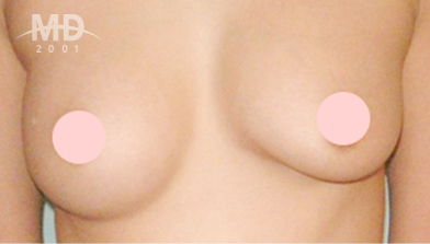 Breast Revision Surgery