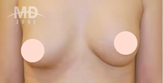 Breast Revision Surgery
