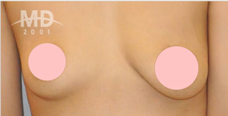 Breast Revision Surgery