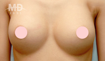 Breast Revision Surgery