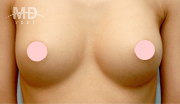 Breast Revision Surgery