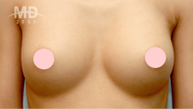 Breast Revision Surgery