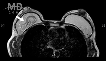Breast Revision Surgery