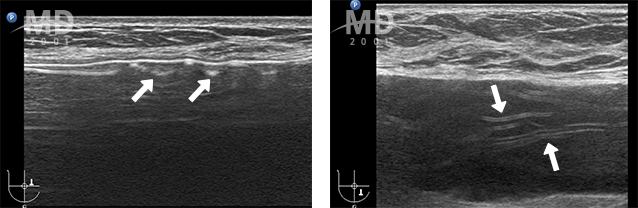 Breast Revision Surgery