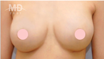Breast Revision Surgery