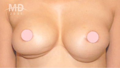 Breast Revision Surgery