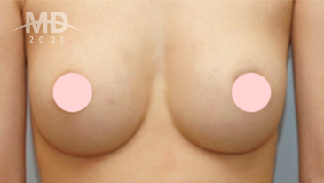 Breast Revision Surgery