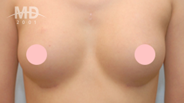Breast Revision Surgery