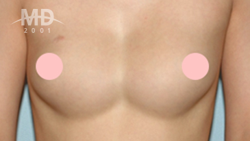 Breast Revision Surgery