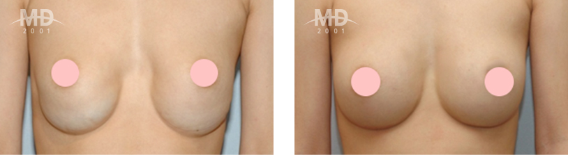 Breast Revision Surgery