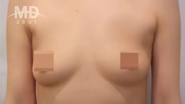 Breast Revision Surgery