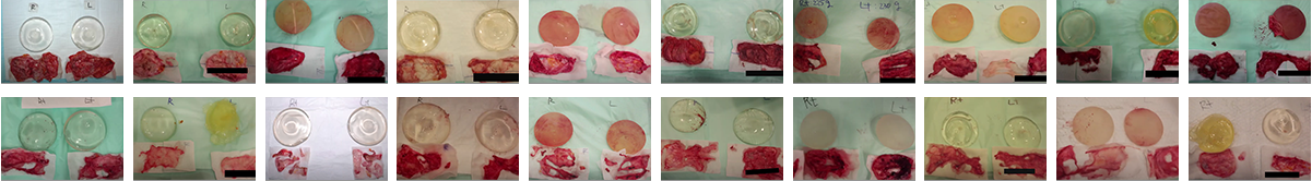 Breast Revision Surgery