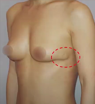Breast Revision Surgery