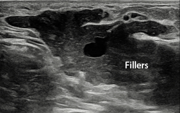 Breast Revision Surgery