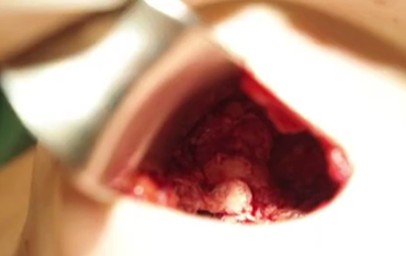Breast Revision Surgery